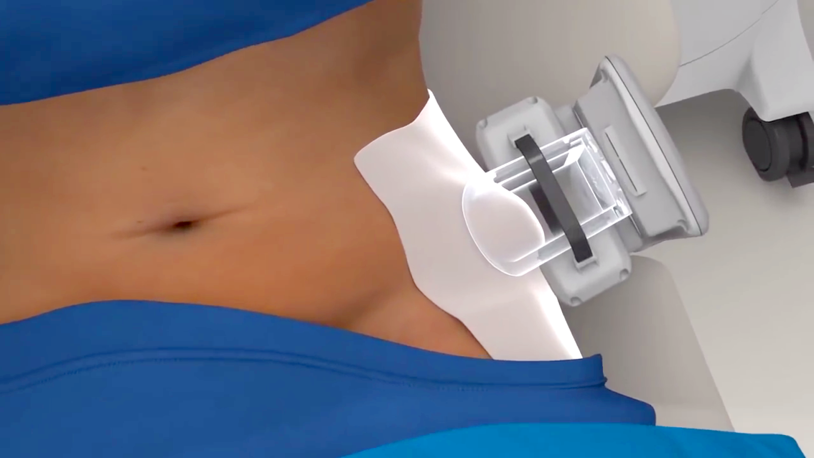 CoolSculpting