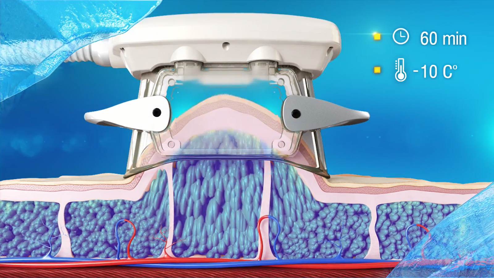 Cutis-Laser-Clinics-ZLipo