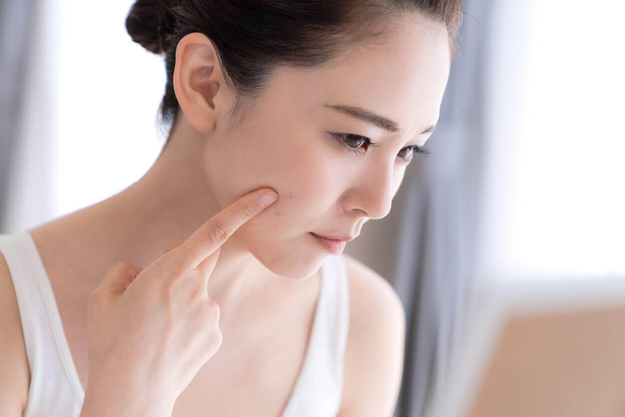 Got Acne? Here are Your Treatment Options