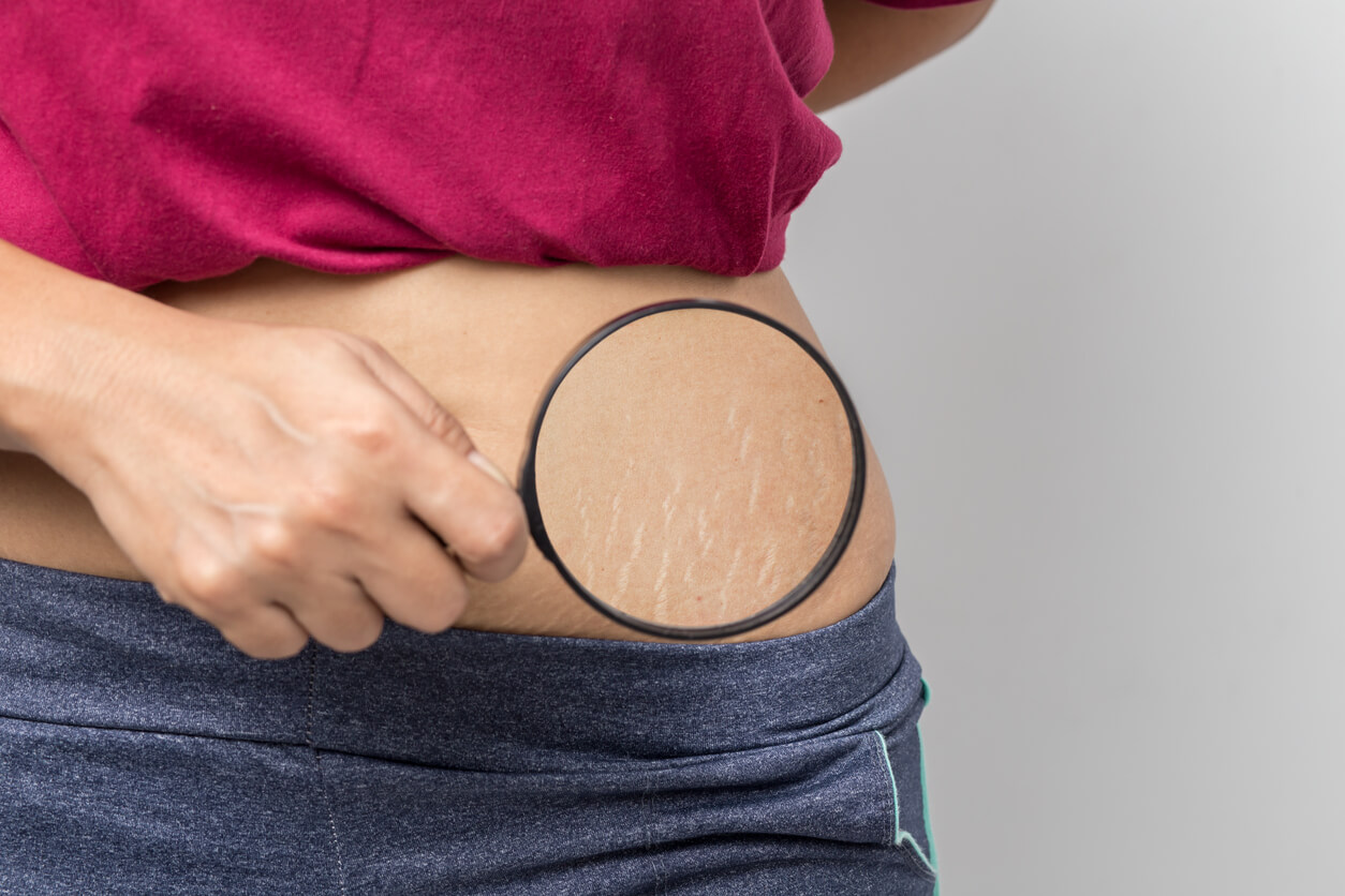 Why Stretch Marks Appear and How to Remove Them Effectively