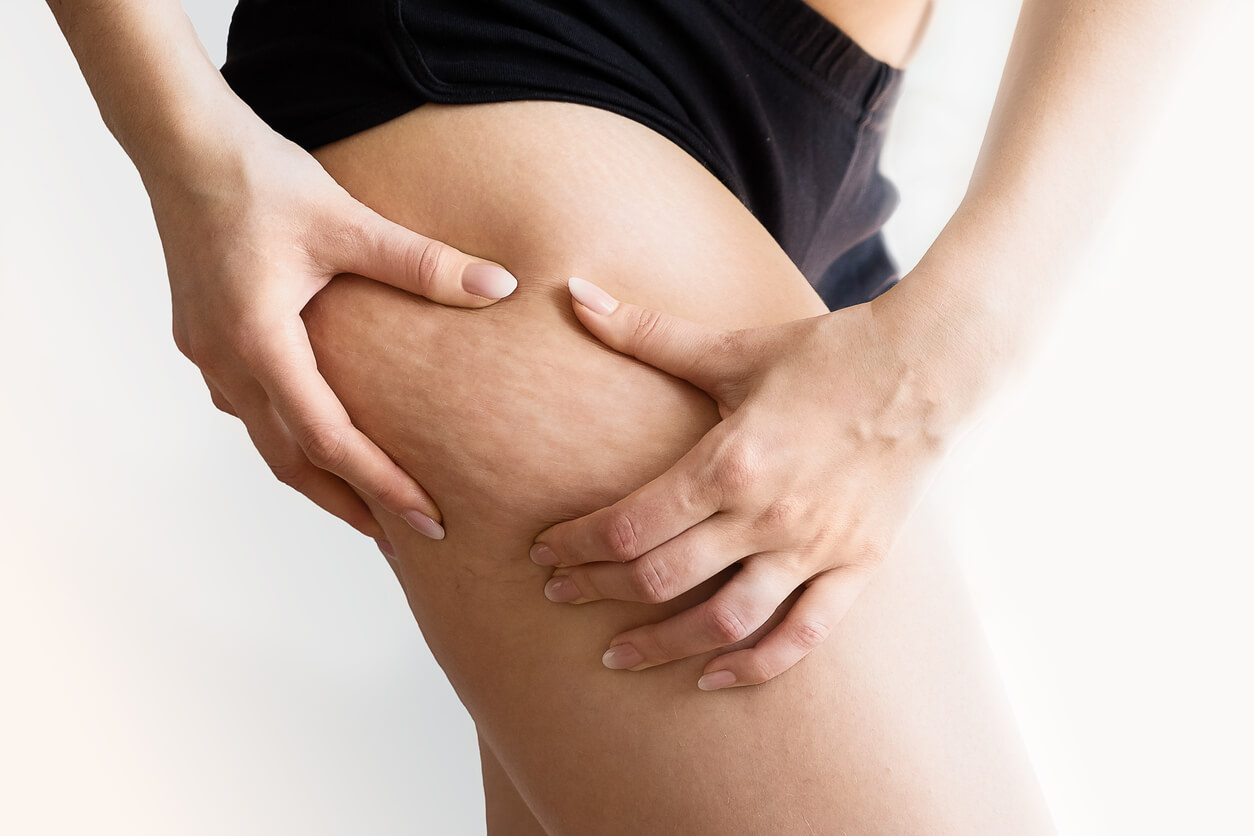 Getting Rid of Cellulite: Is Exercise Enough?