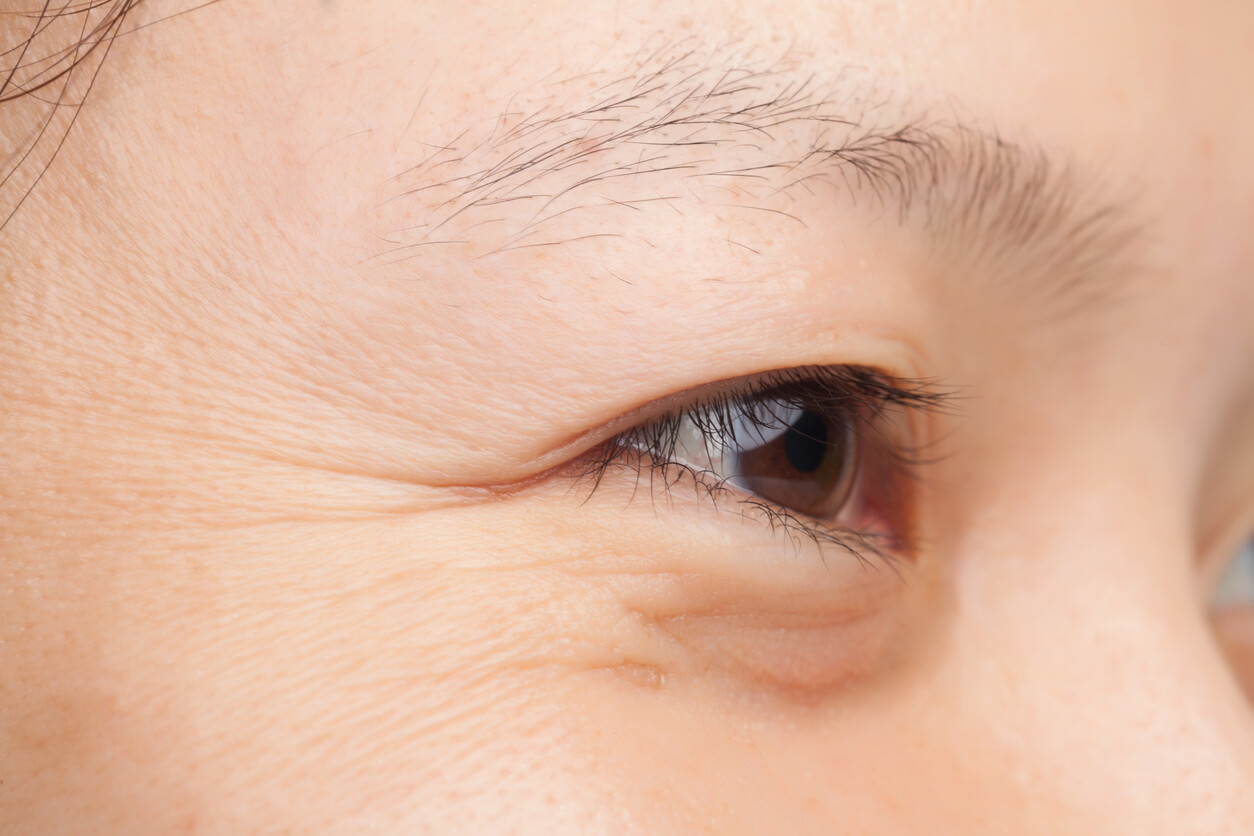 Got Lines and Wrinkles Around Your Eyes? Here’s the Truth About Your Treatment Options