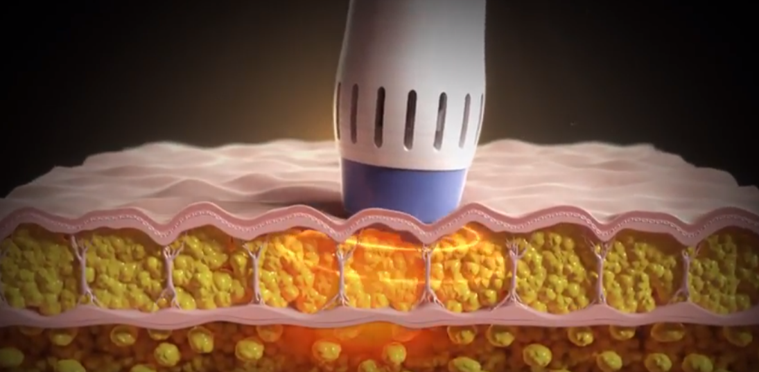 Acoustic Shockwave Therapy