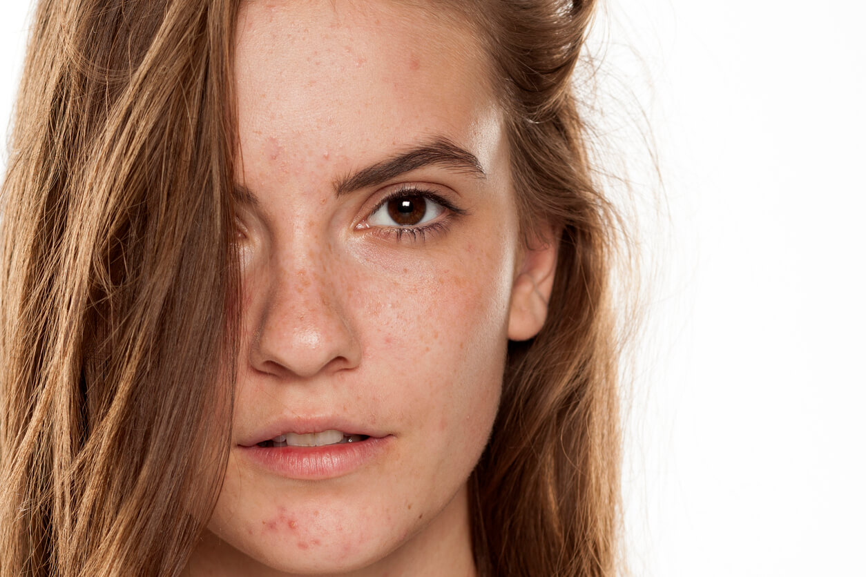 Is There a Cure for Melasma?