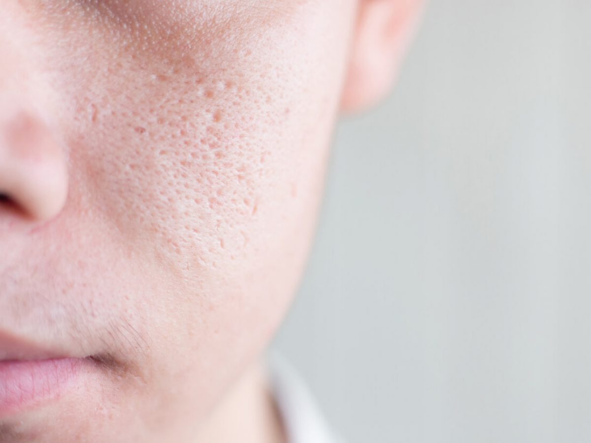 Discover more than 134 hair follicles on face dedaotaonec