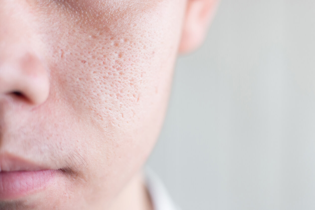 Do Your Pores Look Big? Here’s Why