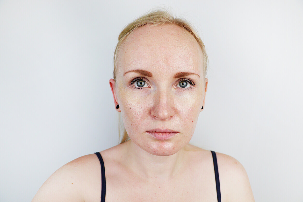 Can Melasma Go Away on Its Own? 