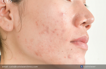 8 Surprising Things That Can Trigger Acne