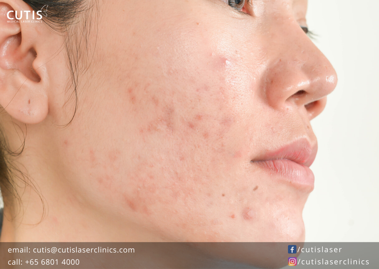 8 Surprising Things That Can Trigger Acne- Cutis Laser Clinics