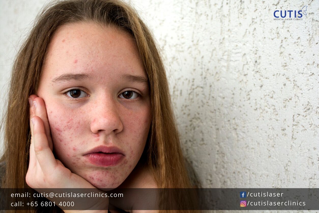 Adult Acne: 5 Things You Need to Know