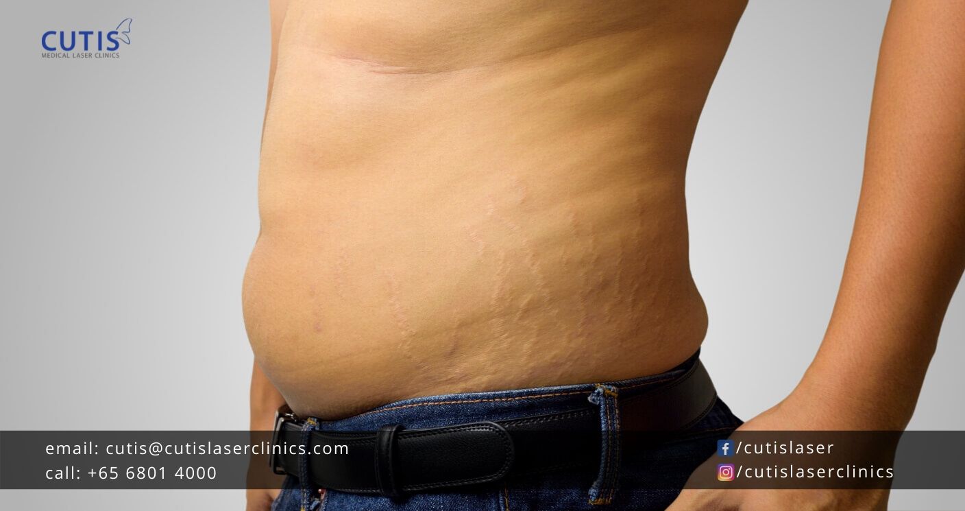 Do Stretch Marks From Puberty Go Away?