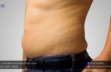 Stretch Marks in Men: Causes and Treatments