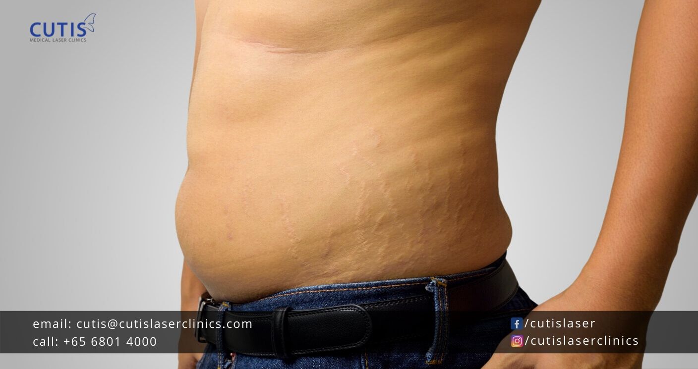 Stretch Marks in Men: Causes and Treatments
