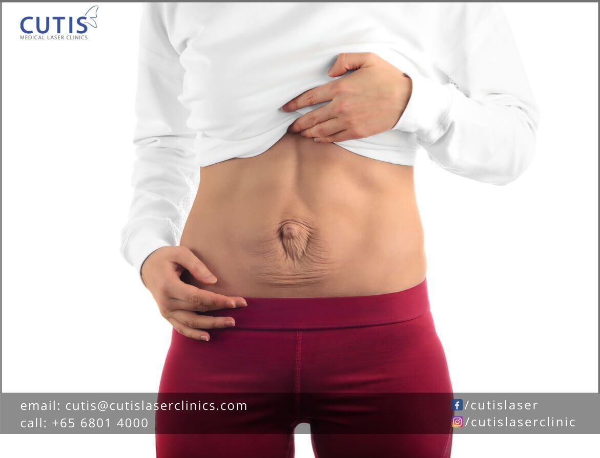 Diastasis Recti Abdominis (DRA)