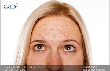 What’s the Deal with Forehead Acne?