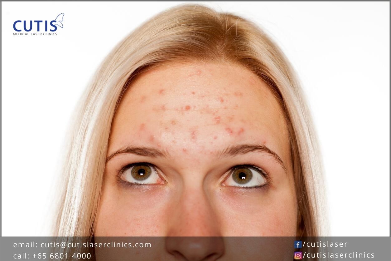 What’s the Deal with Forehead Acne?