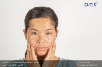 How Hormones Affect Your Skin