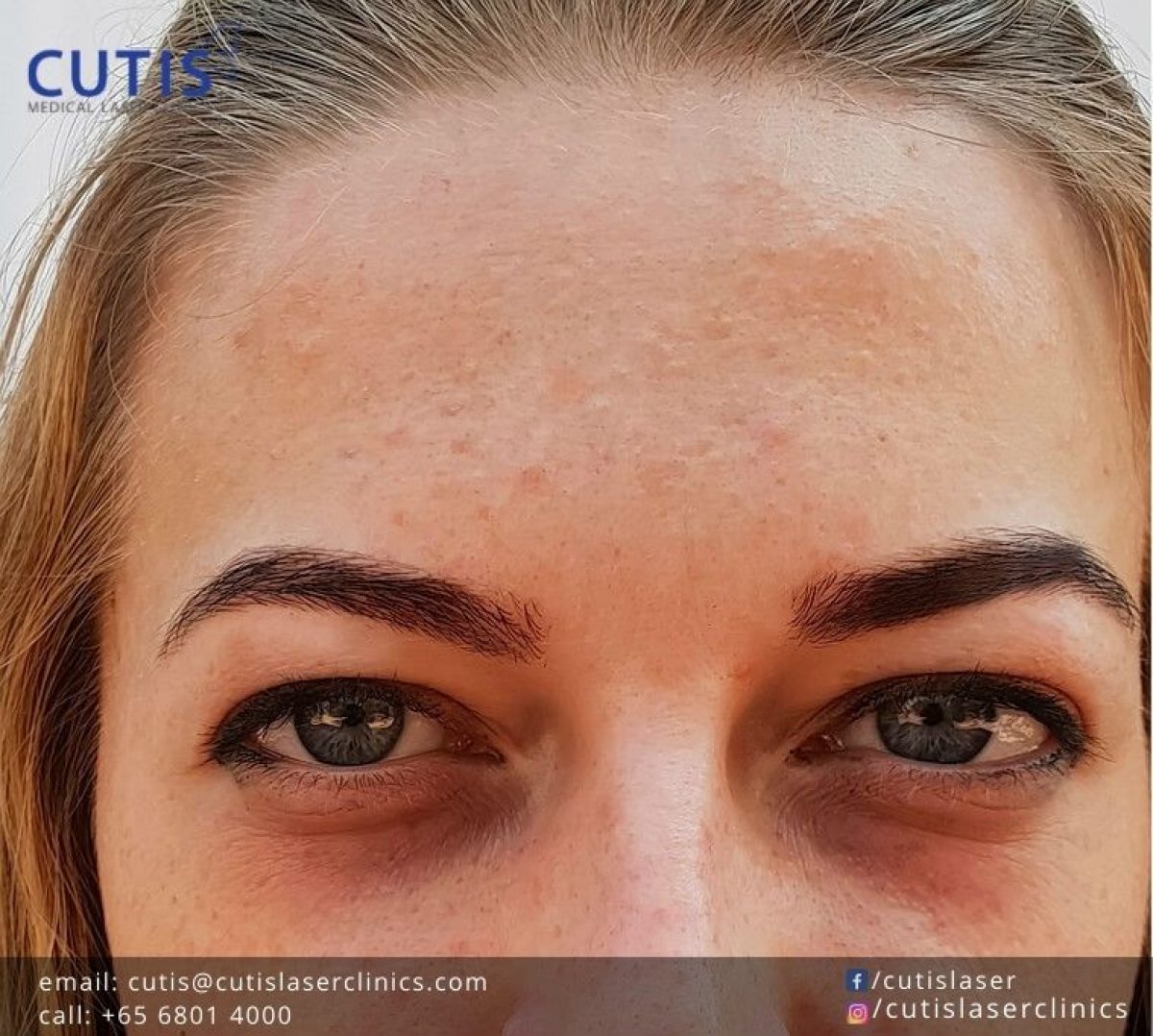 Does Eye Cream Work for Dark Circles?- Cutis Laser Clinics in Singapore