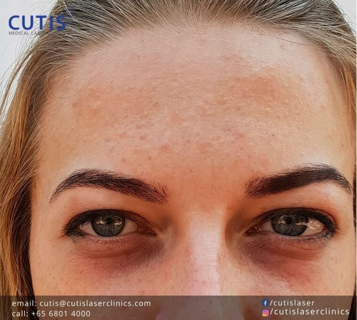 Does Eye Cream Work for Dark Circles?- Cutis Laser Clinics in Singapore Does Eye Cream Work for Dark Circles?- Cutis Laser Clinics in Singapore