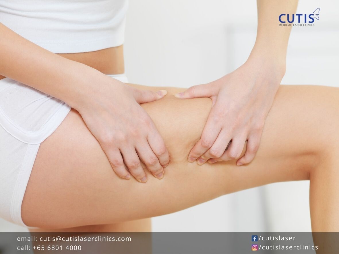 Reduce Cellulite with Exilis Ultra 360 & Acoustic Shockwave Therapy