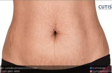 Stretch Marks: Why Do Some Women Get Them and Others Don’t?