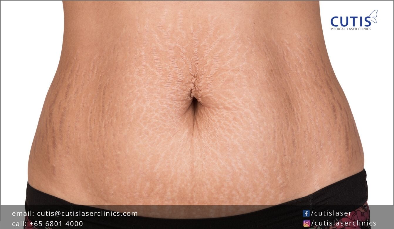 Stretch Marks: Why Do Some Women Get Them and Others Don’t?