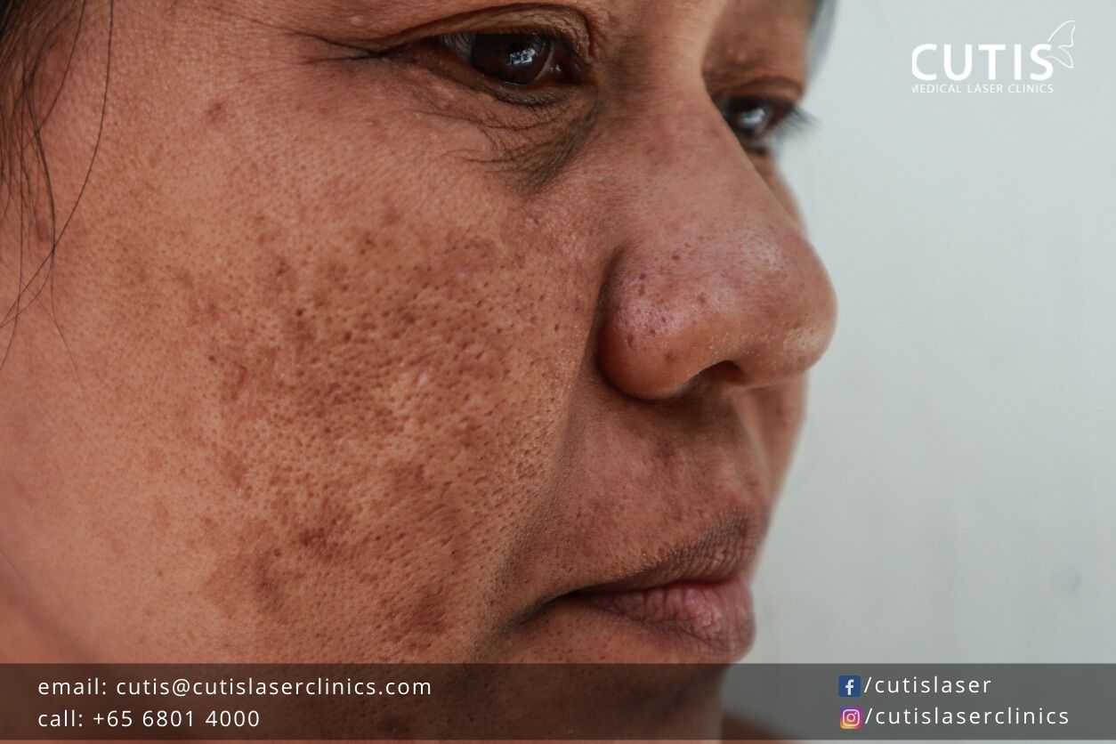 Your Common Questions About Melasma Answered