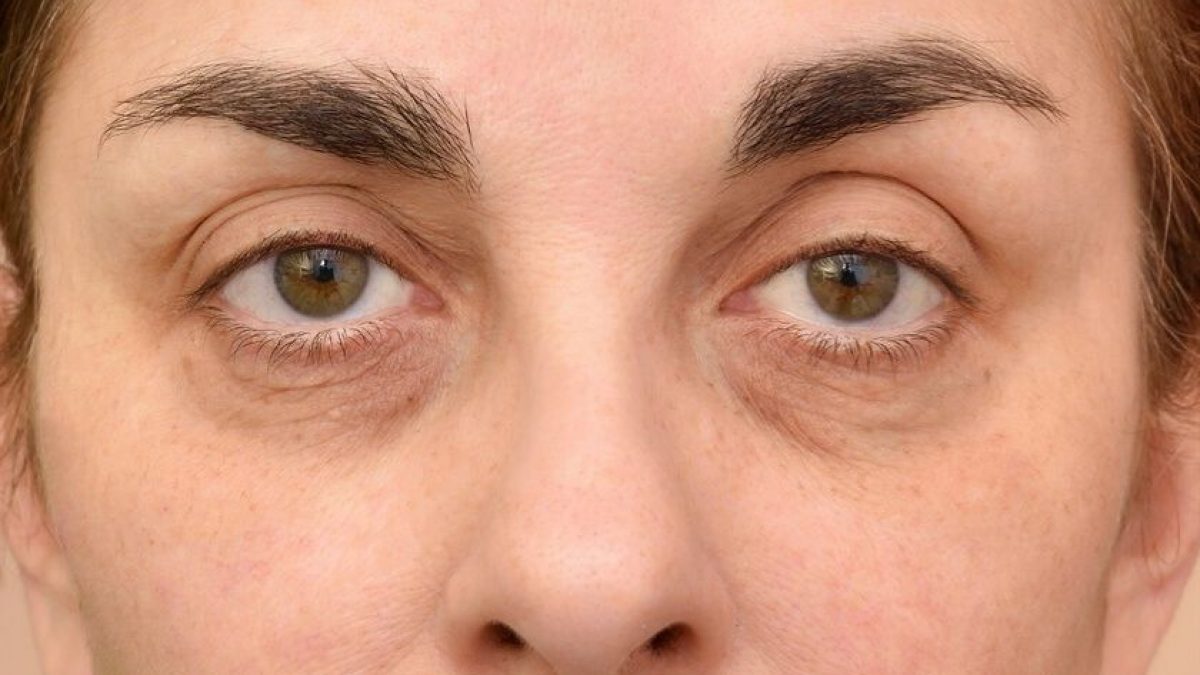 Reduce Eye Bags - Bemedispa