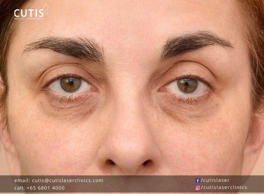 Sunken Eyes Causes Remedies And Tips To Prevent