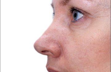 Treat and Improve Skin Imperfections with PicoCare Laser Treatments