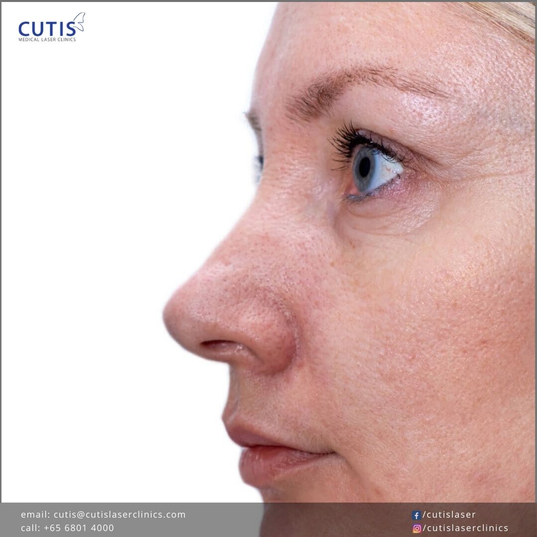 Treat and Improve Skin Imperfections with PicoCare Laser Treatments