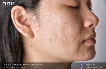 Pearl Resurfacing: Transform and Rejuvenate Your Skin with a Pearl-Like Glow