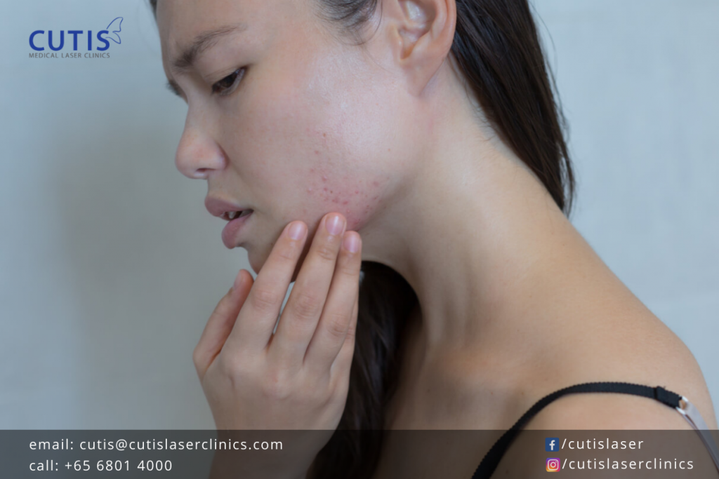 What Causes Sudden Breakouts? Read and Learn