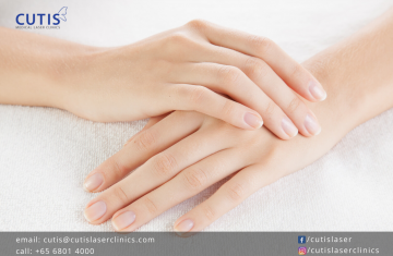 Bothered with Aging Hands? Try RADIESSE®