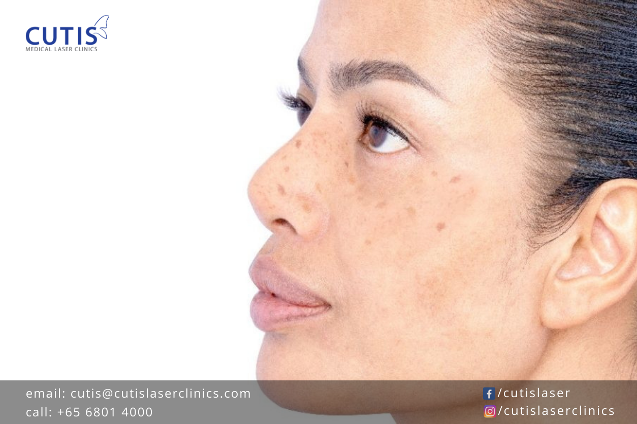 How PicoCare Laser Effectively Removes Stubborn Pigmentation