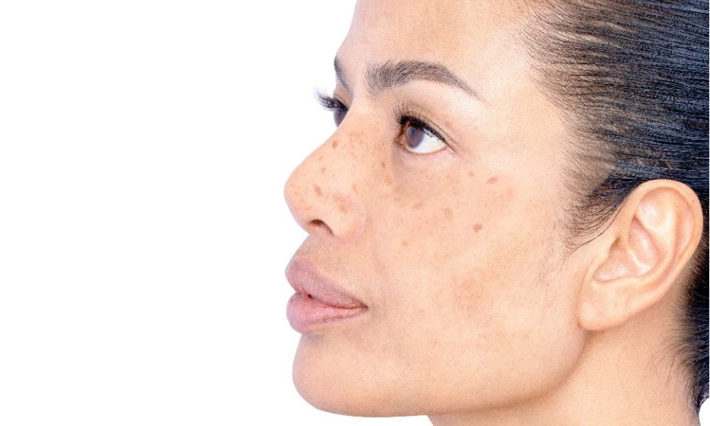 How PicoCare Laser Effectively Removes Stubborn Pigmentation