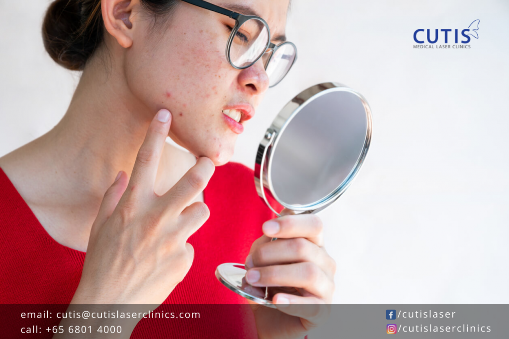 What Does Itchy Acne Mean? Cutis Medical Laser Clinics