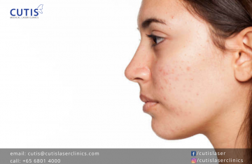 Treating Scars and Pigmentation: PicoCare Lasers vs Traditional Lasers