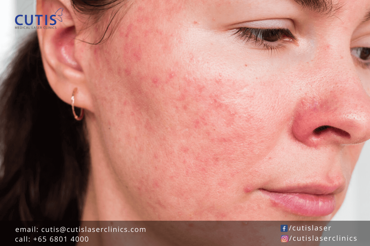 What Are Those Tiny Bumps on Your Face?
