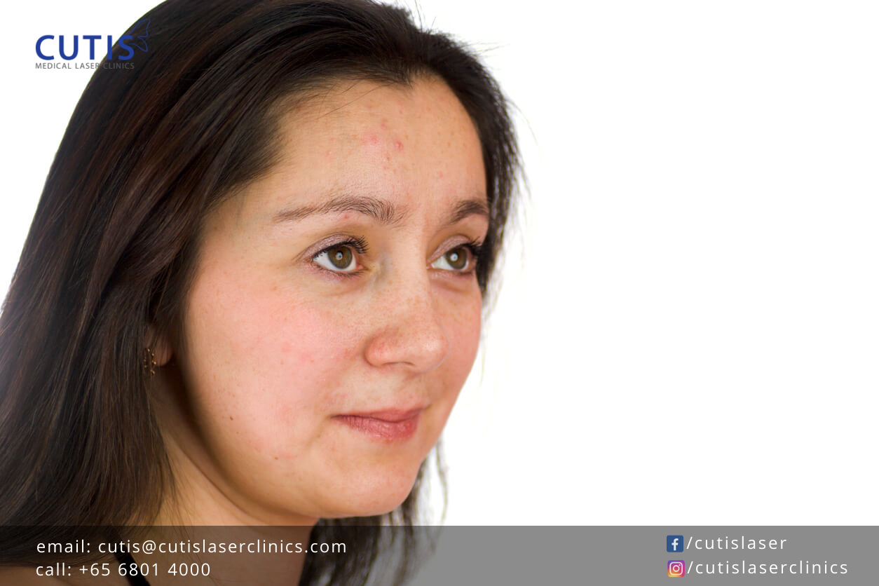 Acne Scars Treatment: Laser, Injectables, or Microneedling?