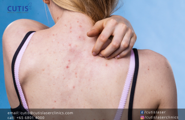 Back Acne (Bacne), Pigmentation, and Scarring: What Can Help?