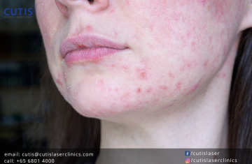 Do You Have Rosacea? Here are the Treatments That Can Help