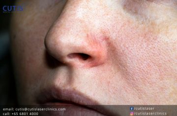 Do You Have Spider Veins on Your Face?