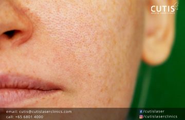 Treating Stubborn Pigmentation: Can Oral Supplements Help?