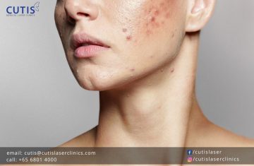 The Difference Between Acne and Pimples