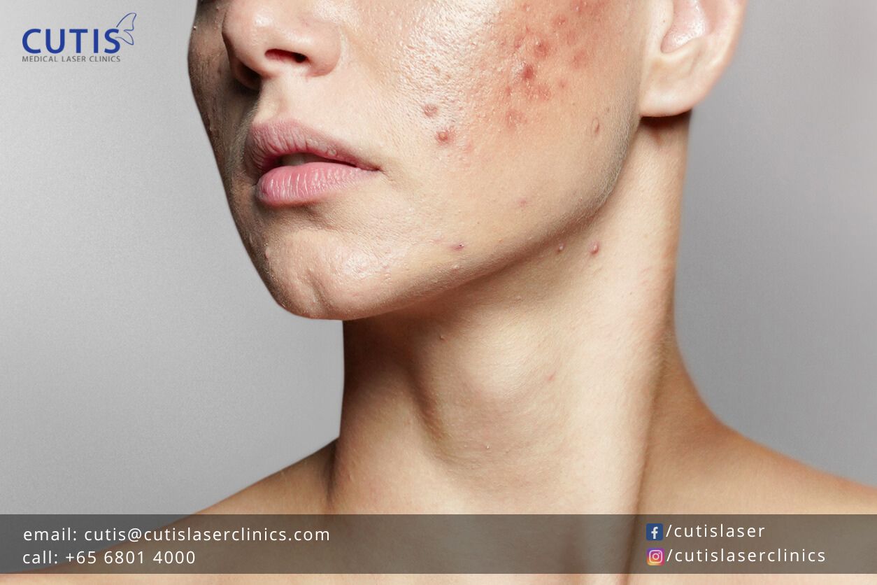The Difference Between Acne and Pimples