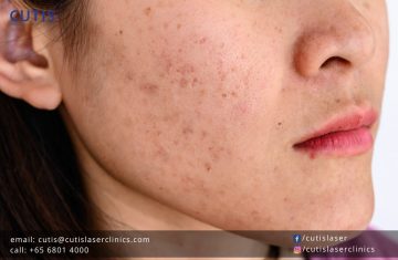 What Makes Asian Skin Prone to Pigmentation?