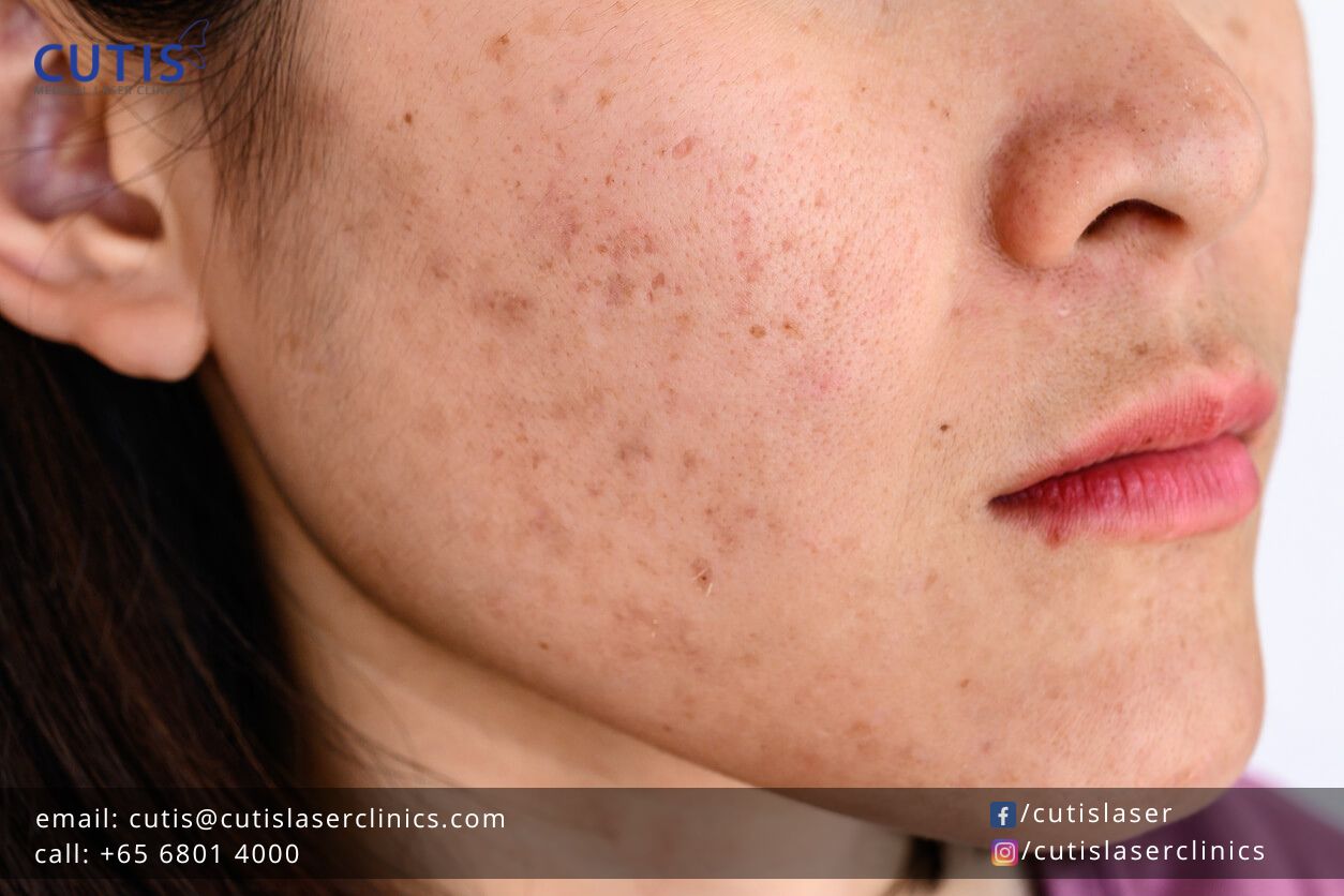 What Makes Asian Skin Prone to Pigmentation?