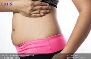 11 Questions About Stretch Marks Answered