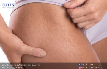 Cellulite vs Stretch Marks: What’s the Difference?